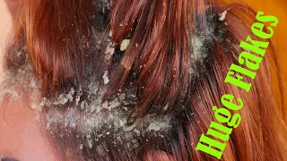 Huge flake !! itchy scratching dandruff scalp on my brother's head #57