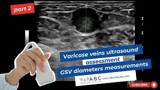 Varicose veins ultrasound assessment: great saphenous vein diameters measurements