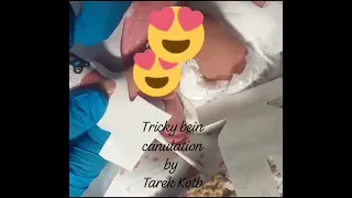 Tricky bein Canulation by Prof.  dr. Tarek Kotb