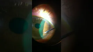 Corneal foreign body removal with insuline needle