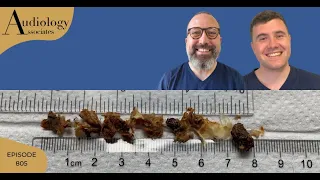 EAR WAX REMOVAL COMPILATION INC MASTOID CAVITY CLEARANCE- EP805