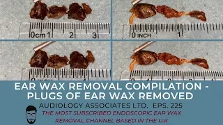 EAR WAX REMOVAL COMPILATION - PLUGS OF EAR WAX REMOVED - EP 225