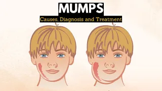 Mumps, Causes, Signs and Symptoms, Diagnosis and Treatment.