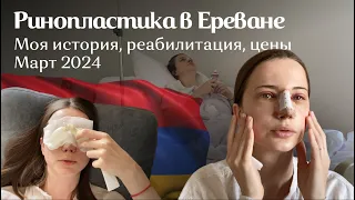 Ринопластика в Ереване | Моя история, реабилитация, цены | Март 2024