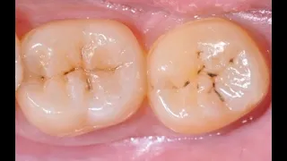 Después de ver esto, querrás ir al Dentista. (caries gigante)