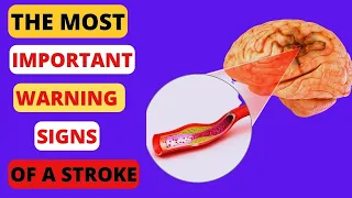 The Most Important Warning Signs Of Stroke One Month Before