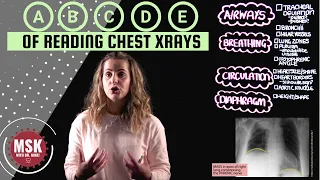 Learning the ABCDEs of Chest Xray