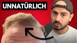 Haartransplantation | Künstliches Ergebnis nach 17 Monaten | Erfahrung