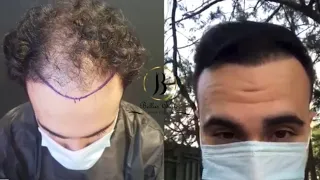 Результат пересадки волос через 10 месяцев / 10 months hair transplant result