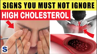 9 Signs and Symptoms of High Cholesterol You Must Not Ignore