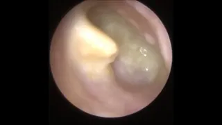 762 - Ear Pus Swimmer's Ear Infection