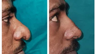 nasal tip plasty.smas reduction dr jalil mujawar