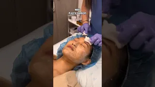 Check out our process for a VI Peel 🤩 #shorts #facial