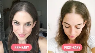 How I Coped With Extreme Hair Loss After Pregnancy I Mom Bod