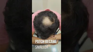 Treating Alopecia Areata to get full hair growth!