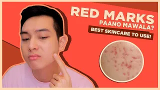 How to FADE RED MARKS FASTER with SKINCARE + DOs & DONTs | Jan Angelo