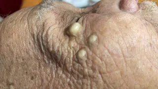 Remove Super Terrible Old Acne Of The Old Woman