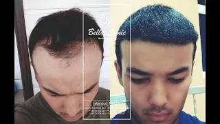 Hair transplant result 4500 grafts / Результат пересадки волос 4500 графтов