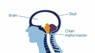 Understanding Chiari malformation