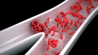 Amplify Sickle Cell Voices Ten +2 Series One - Introduction to #SickleCellDisease