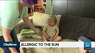 Genetic condition makes baby girl allergic to sun