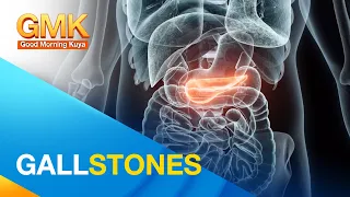 Gallstones: saan ito nakukuha at paano ito maiiwasan?