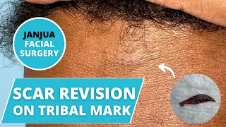 TRIBAL MARK SCAR REVISION ON FOREHEAD  - DR. TANVEER JANJUA - NEW JERSEY