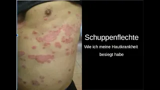 Schuppenflechte, wie ich meine Hautkrankheit besiegt habe