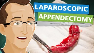 Laparoscopic Appendectomy