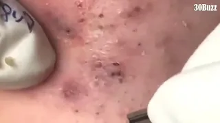 05 Huge Acne Pimples Blackheads Popping Up Satisfying with Oddly Calm Music