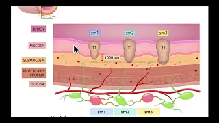 Colonoscopy: Colon wall anatomy for EMR and ESD - Medical Illustration