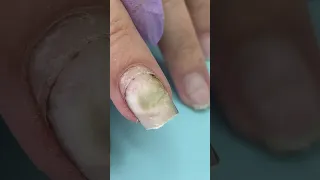 What Happened 🤢After Using Nail Glue