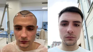 Результат пересадки волос через 8 месяцев / hair transplant result after 8 months