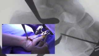 Modified Evans Procedure | Dr. David Feldman