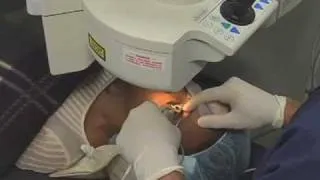 LASIK Surgery by Dr Dan Beers in Mountain View, CA