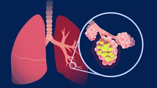 Understanding Pneumococcal Pneumonia