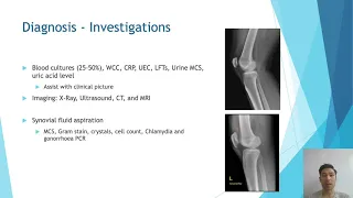 Septic Arthritis by Dr Tim Wright