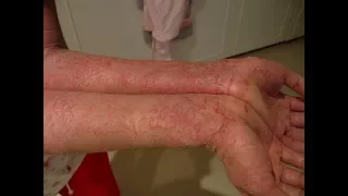 Treatment of eczema and other skin diseases