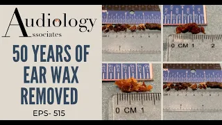 50 YEARS OF EAR WAX REMOVED - EP515