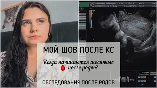 МЕСЯЧНЫЕ ПОСЛЕ РОДОВ И КС НА ГВ 🩸ШОВ ПОСЛЕ КЕСАРЕВО • обследования после родов