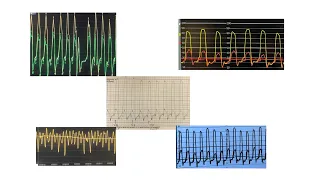 Constriction vs Myocardial disease: practice cases and tracings. Misunderstood concepts.Board review