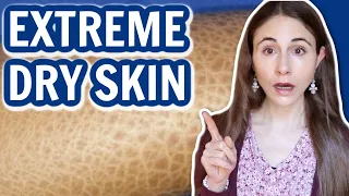 SIGNS OF EXTREME DRY SKIN // ICHTHYOSIS VULGARIS @DrDrayzday
