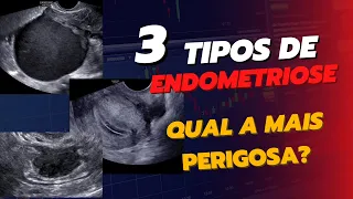 O 3 tipos de ENDOMETRIOSE: Qual o mais perigoso?