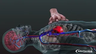 La RCP (Réanimation Cardio-Pulmonaire) animation 3D