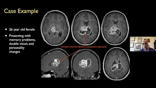 🧠 Approaches to The Thalamic Gliomas:Pitfalls and Surgical Tricks - Mustafa K. Başkaya, M.D.