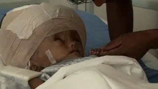 Indian medics operate on baby with swollen head