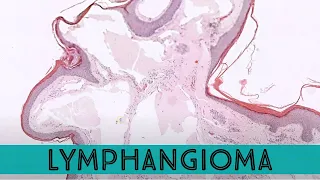 Lymphangioma (Lymphatic Malformation) under the microscope (pathology dermpath dermatology)