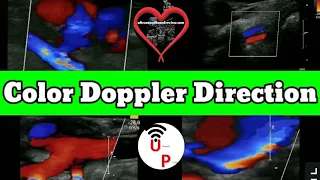 Color Flow Doppler Direction Tutorial