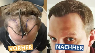 Haartransplantation Schmerzen & Corona | Patient offen und ehrlich!