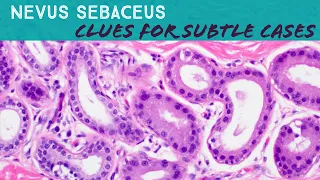 Nevus Sebaceus (subtle clues vs classic): Dermpath in 5-Minutes (dermatology pathology birthmark)